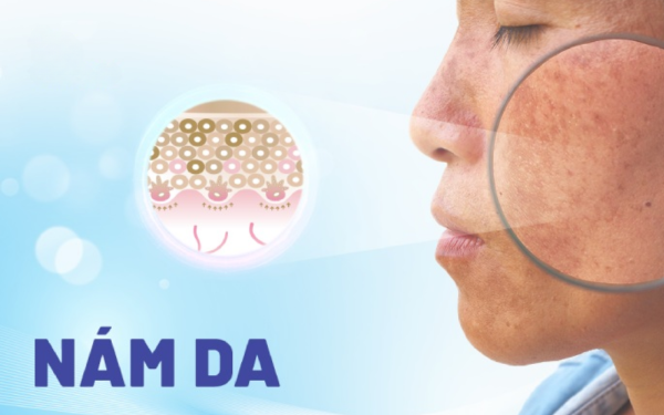 Vì sao phụ nữ Nhật ít nám dù không treatment mạnh 
