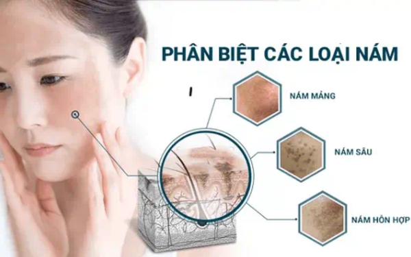 Vì sao phụ nữ Nhật ít nám dù không treatment mạnh 